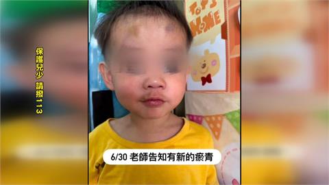 停托保母涉虐待！　孩子身上多處咬痕.瘀傷　母控保母虐待