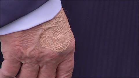 健康亮紅燈？手部驚見「神秘瘀青」　川普自曝每日大量服用阿斯匹靈