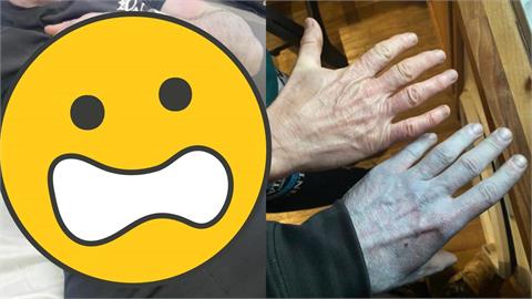 男裸睡醒來「全身變藍」送急診！超詭狀態流出「醫護全嚇壞」真相超糗