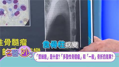 這麼恐怖！多發性骨髓瘤的「駭人症狀：食骨性病變」　脊髓如果被吃掉導致半身不遂！