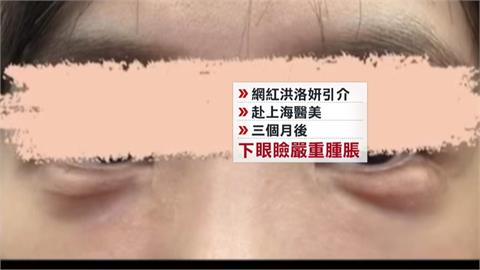 網紅洪洛妍「仲介中國醫美」鬧糾紛！　女花逾11萬元動刀遭毀眼