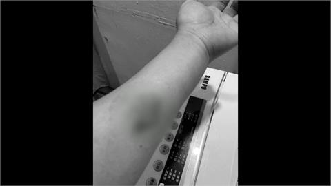 男子家門前抽菸與鄰爆口角　妻子勸架竟被咬傷還留齒痕