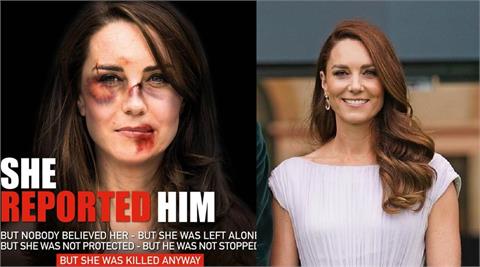 快新聞／英國凱特王妃被家暴了？　臉上布滿「瘀青和被鞭打痕跡」照片曝光
