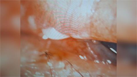 罕見！高雄女遭瑪爾濟斯狠咬　「狗牙卡眼」險失明