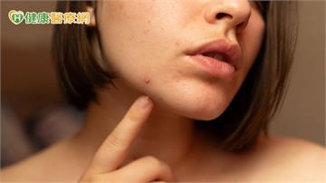 不只青春期！醫：痘痘也困擾上班族、更年期婦女　研究揭僅3成就醫