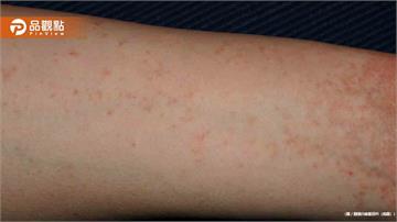 32歲女子全家「夜夜癢醒」醫師曝恐怖傳染真相