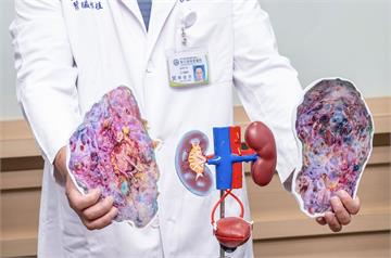 補教師「腎臟腫大20倍」 靠醫切除6公斤多囊腎+活腎移植重生