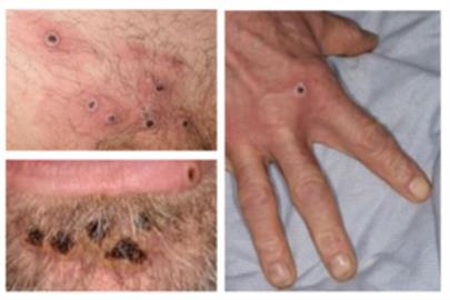 快新聞／猴痘確診「集中特定群體」  美國CDC：飛沫、皮膚傷口也是傳染途徑