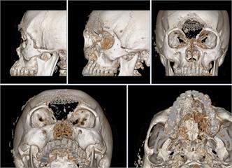 男遭T91步槍傷臉骨粉碎! 三總醫巧手+3D列印「拚回整張臉」