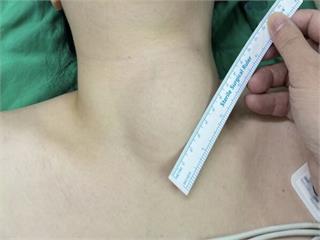 轉頭卡卡！吃東西越來越不順   她脖子驚冒8公分大結節