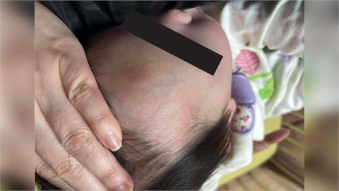 快新聞／剴剴案翻版？1歲童送安置機構疑遭施暴　頭部等處瘀青畫面曝光