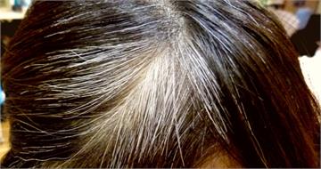 未滿40歲狂長白髮？營養師揭關鍵　多吃5食物有救