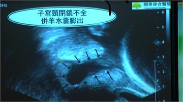 子宮頸過短易流產 超音波及早發現保胎兒