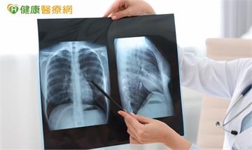 晚期肺癌治療進入組合療法時代　醫：第一線治療策略攸關後續布局
