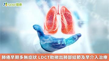 肺癌早期多無症狀 LDCT助揪出肺部結節及早介入治療