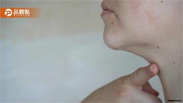 中醫師揭密！下巴爆痘、水腫暴增竟是婦科警訊