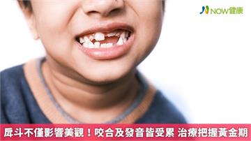 戽斗不僅影響美觀！咬合及發音皆受累 治療把握黃金期