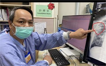 壯男日本旅遊「咳二天就送急診」   醫一見已肺膿瘍合併肺炎