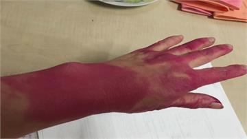 戴乳膠手套大掃除 一脫下來整手被染紅....怎麼辦？
