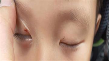 三峽古蹟拱橋施工傷路人 5歲男童眼睛慘遭割傷