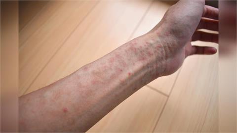 北市外籍男確診麻疹「足跡集中士林區」　衛生局急匡列164人