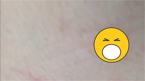 台灣首例猴痘照片曝光！「腿部密集冒痘」衛生局：與國外不太一樣