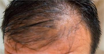 狂吃蛋能生髮？男每天吞3顆生蛋救髮際線　醫示警：結果恐更慘