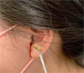 女童喊左耳疼痛 聯新國際醫檢查竟是蟋蟀卡耳道