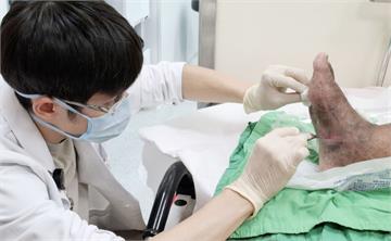 糖尿病男踩尖物「腳底破了一點皮」   再看已紅腫化膿、壞死險截肢！
