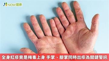 全身紅疹竟是梅毒上身 手掌、腳掌同時出疹為關鍵警訊