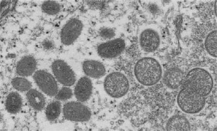 猴痘擴散全球16國 密切身體接觸易感染