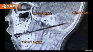 6歲童吃麥芽糖摔倒！「竹籤從口腔刺到顱底」險喪命