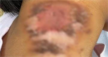 「行走的硫酸」大爆發！4歲妹沾到毒液脖子潰爛　20多天好不了
