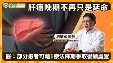 肝癌晚期不再只是延命　醫：部分患者可藉1療法降期爭取後續處置