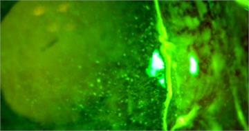 騎車遭蚊蟲飛入眼！男直覺「1動作」慘了　角膜差點爛穿險失明