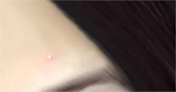 痘痘貼用錯更慘！　醫列「3種痘痘」不適合貼：恐讓發炎升級