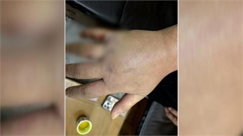 討債不成棍棒伺候　花蓮男欠八千元遭鐵鎚敲手腫脹
