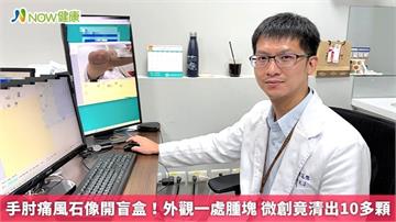 手肘痛風石像開盲盒！外觀一處腫塊 微創竟清出10多顆
