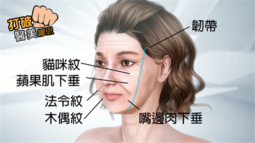 剪皮不等於拉皮！同步國際醫學論文發表拉皮論點