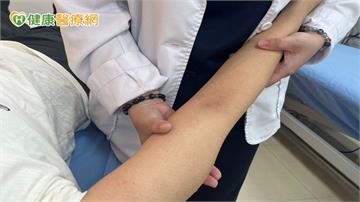 乳癌術後手臂淋巴水腫　醫師教簡易自我檢測與退腫處置