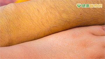 出現黃疸是肝病上身？　醫：皮膚還沒黃「這裡」就看出跡象
