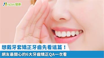 想戴牙套矯正牙齒先看這篇！ 網友最關心的6大牙齒矯正QA一次看