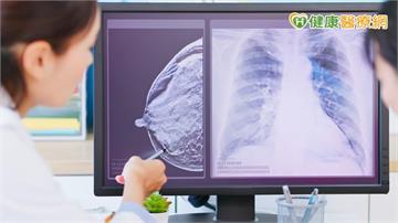 51歲婦乳房摸到硬塊確診乳癌 乳房保留手術結合新型放射治療降復發