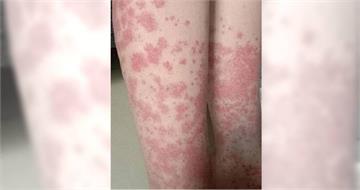 20歲女大生瘋漂染頭髮！2年內每月一次　她全身爆紫斑「剃光頭保命」