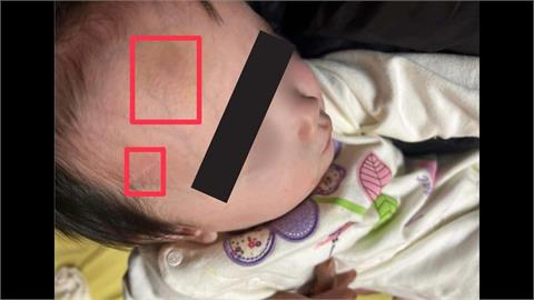 剴剴案翻版?1歲童臉部紅腫瘀青 社工竟稱「被蚊子叮」