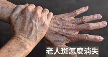 老人斑不只是老化！醫揭「全身警訊」　心臟、腦部也在變老