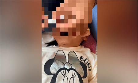4歲童看牙科從椅子重摔下巴縫5針　家長控院方處理消極