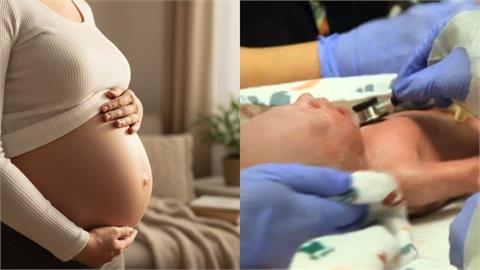 孕婦難產…接生硬拉「扯斷頭」！男嬰慘遭「分成2截」頭顱卡媽媽體內