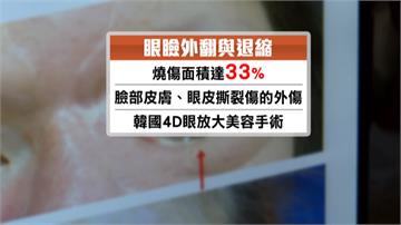 燒傷害下眼瞼退縮 婦人微整形恢復笑容