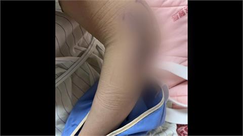 八卦山「天空遊戲場」溜滑梯　國中生腳骨折再傳女子手骨折